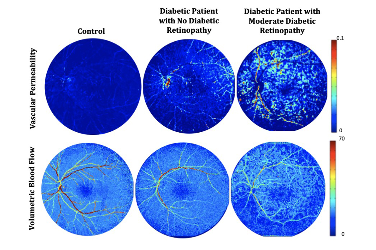 Biomedical Engineering Professor Awarded $2.5 Million Grant to Prevent Vision Loss in Diabetes Patients - Vimarsana News